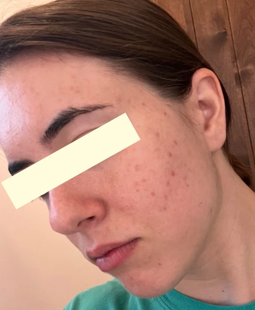 Naturopathic and holistic acne doctor Dr. Sheyda Vadipour helps you heal your acne naturally and achieve clear skin through functional lab testing, hormone and gut healing, and root-cause medicine.