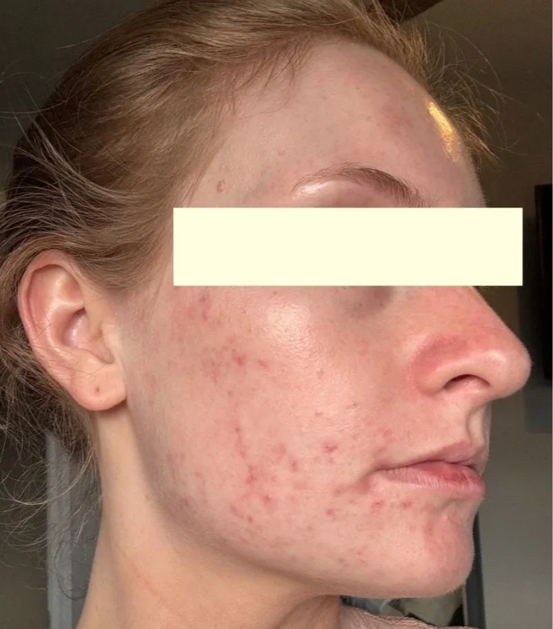 Naturopathic and holistic acne doctor, Dr. Sheyda Vadipour, helping you heal acne naturally and achieve clear skin through functional lab testing, hormone and gut healing, and root-cause medicine.