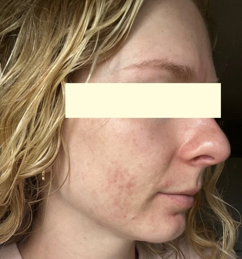 Naturopathic and holistic acne doctor, Dr. Sheyda Vadipour, helping you heal acne naturally and achieve clear skin through functional lab testing, hormone and gut healing, and root-cause medicine.