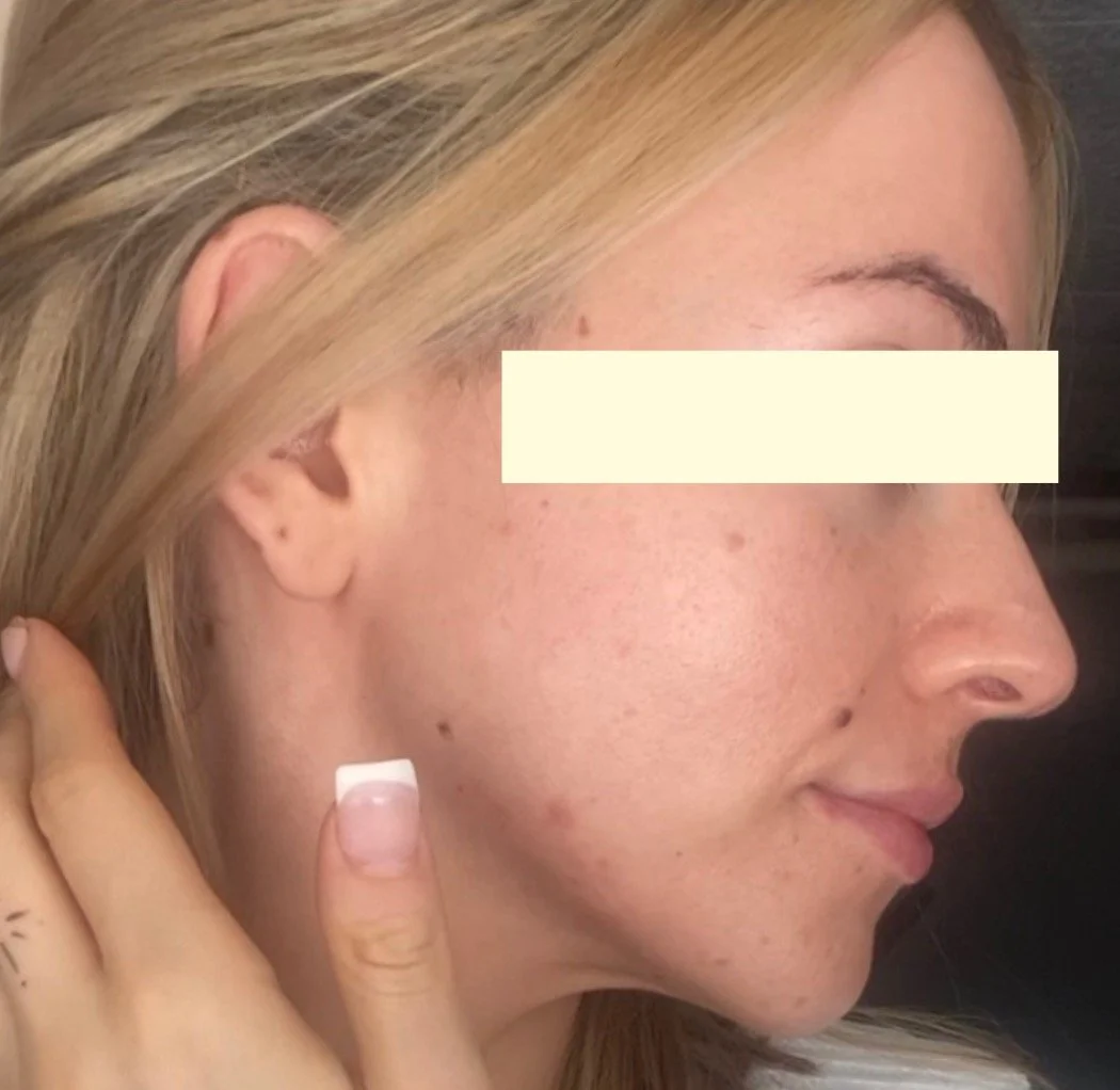 Naturopathic and holistic acne doctor, Dr. Sheyda Vadipour, helping you heal acne naturally and achieve clear skin through functional lab testing, hormone and gut healing, and root-cause medicine.