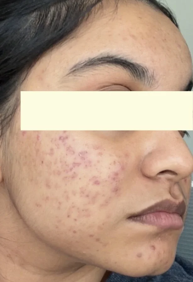 Naturopathic and holistic acne doctor, Dr. Sheyda Vadipour, helping you heal acne naturally and achieve clear skin through functional lab testing, hormone and gut healing, and root-cause medicine.