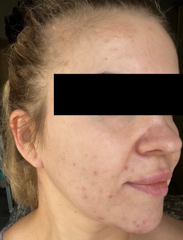 Naturopathic and holistic acne doctor Dr. Sheyda Vadipour helps you achieve lasting clear skin through functional lab testing, hormone and gut healing, and root-cause medicine.