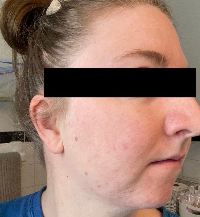 Naturopathic and holistic acne doctor Dr. Sheyda Vadipour helps you achieve lasting heal your acne naturally and achieve clear skin through functional lab testing, hormone and gut healing, and root-cause medicine.