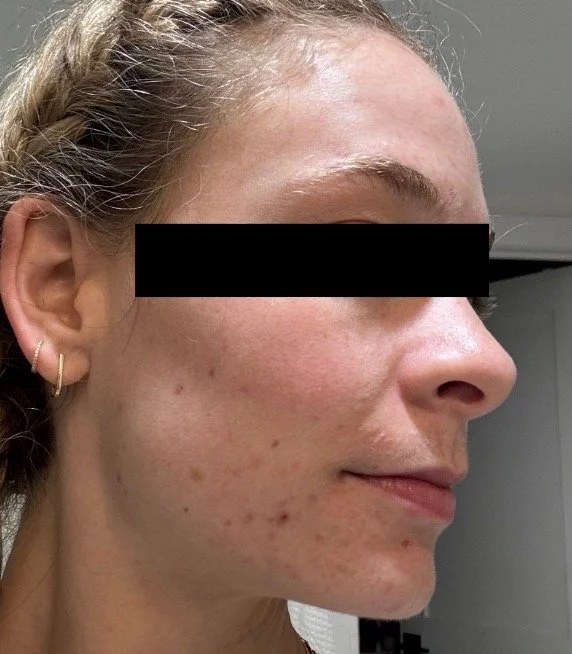 Naturopathic and holistic acne doctor Dr. Sheyda Vadipour helps you achieve lasting clear skin through functional lab testing, hormone and gut healing, and root-cause medicine.