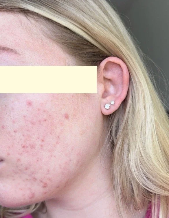 Close-up of a woman's face showing red acne and skin blemishes on her cheek, with blonde hair partially covering her face and two earrings visible in her earlobe.
