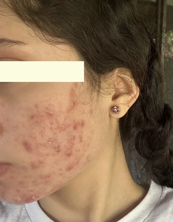 Close-up of a person's face showing severe acne scars and active pimples on the cheek and chin, with a dark hair bun and a pink floral earring.