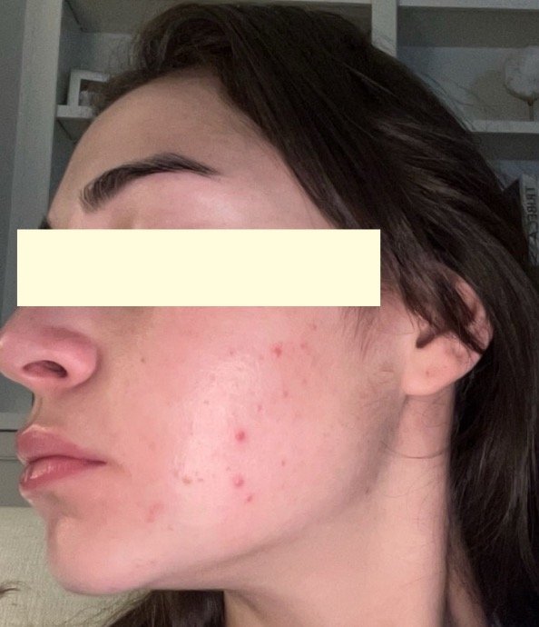Close-up of a woman's face showing mild acne on her cheek.