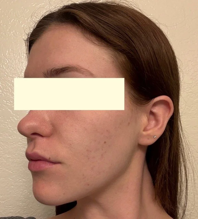 Naturopathic and holistic acne doctor Dr. Sheyda Vadipour helps you heal your acne naturally and achieve clear skin through functional lab testing, hormone and gut healing, and root-cause medicine.