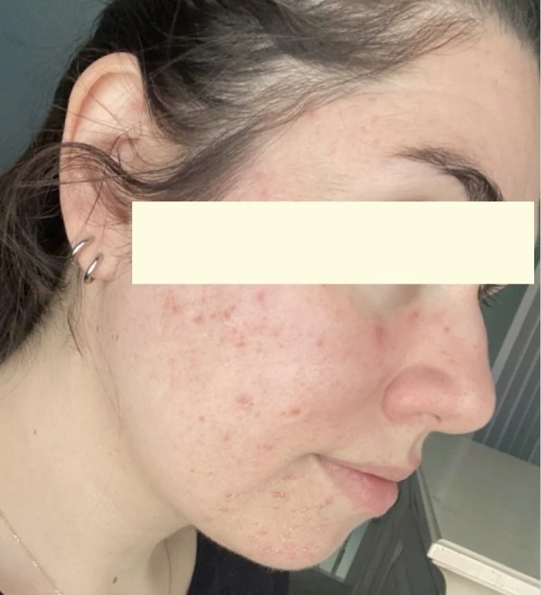 Naturopathic and holistic acne doctor Dr. Sheyda Vadipour helps you heal your acne naturally and achieve clear skin through functional lab testing, hormone and gut healing, and root-cause medicine.