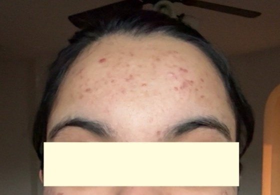 Naturopathic and holistic acne doctor Dr. Sheyda Vadipour helps you heal your acne naturally and achieve clear skin through functional lab testing, hormone and gut healing, and root-cause medicine.