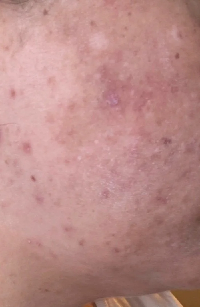 Naturopathic and holistic acne doctor Dr. Sheyda Vadipour helps you heal your acne naturally and achieve clear skin through functional lab testing, hormone and gut healing, and root-cause medicine.