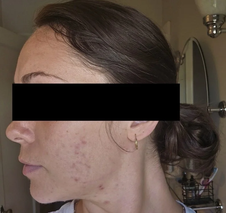 Naturopathic and holistic acne doctor Dr. Sheyda Vadipour helps you achieve lasting clear skin through functional lab testing, hormone and gut healing, and root-cause medicine.