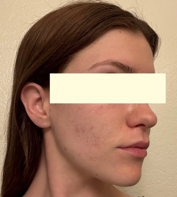 Naturopathic and holistic acne doctor Dr. Sheyda Vadipour helps you heal your acne naturally and achieve clear skin through functional lab testing, hormone and gut healing, and root-cause medicine.