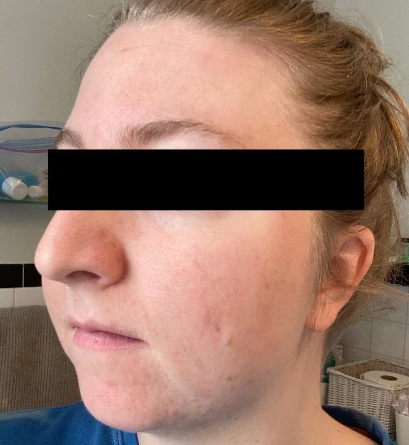 Naturopathic and holistic acne doctor Dr. Sheyda Vadipour helps you achieve lasting heal your acne naturally and achieve clear skin through functional lab testing, hormone and gut healing, and root-cause medicine.