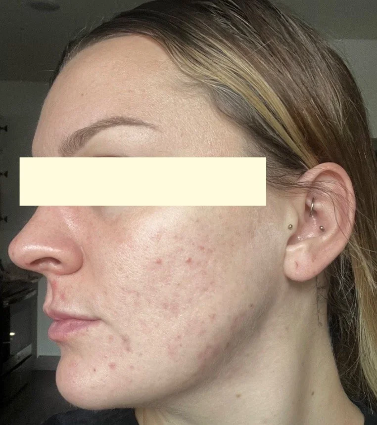 Naturopathic and holistic acne doctor, Dr. Sheyda Vadipour, helping you heal acne naturally and achieve clear skin through functional lab testing, hormone and gut healing, and root-cause medicine.