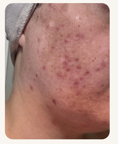 Naturopathic and holistic acne doctor Dr. Sheyda Vadipour helps you heal your acne naturally and achieve clear skin through functional lab testing, hormone and gut healing, and root-cause medicine.