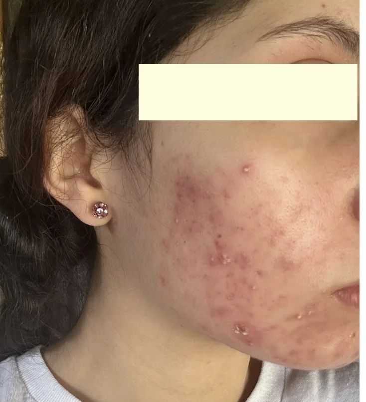 Naturopathic and holistic acne doctor, Dr. Sheyda Vadipour, helping you heal acne naturally and achieve clear skin through functional lab testing, hormone and gut healing, and root-cause medicine.