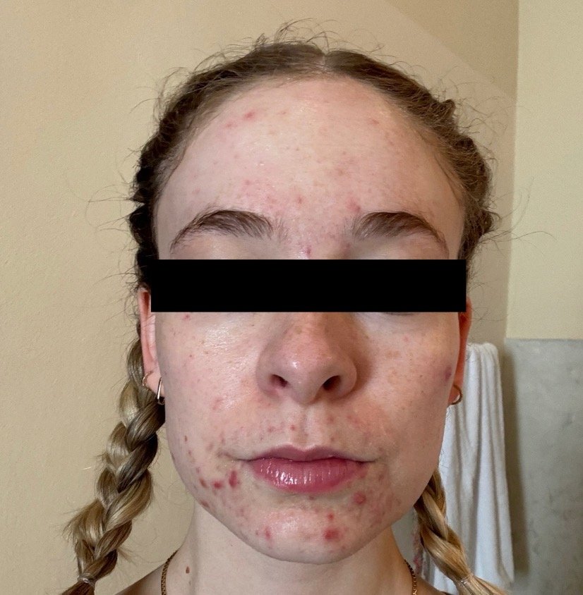 Naturopathic and holistic acne doctor Dr. Sheyda Vadipour helps you heal your acne naturally and achieve clear skin through functional lab testing, hormone and gut healing, and root-cause medicine.