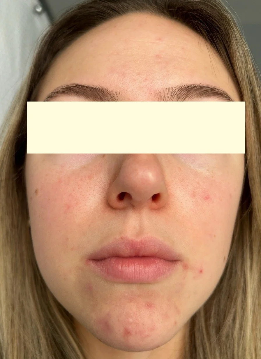 Naturopathic and holistic acne doctor Dr. Sheyda Vadipour helps you heal your acne naturally and achieve clear skin through functional lab testing, hormone and gut healing, and root-cause medicine.