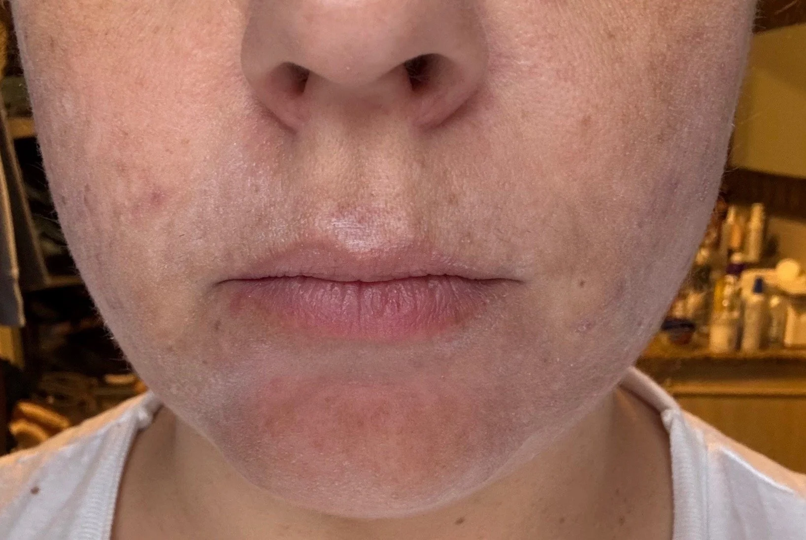 Naturopathic and holistic acne doctor Dr. Sheyda Vadipour helps you achieve lasting heal your acne naturally and achieve clear skin through functional lab testing, hormone and gut healing, and root-cause medicine.