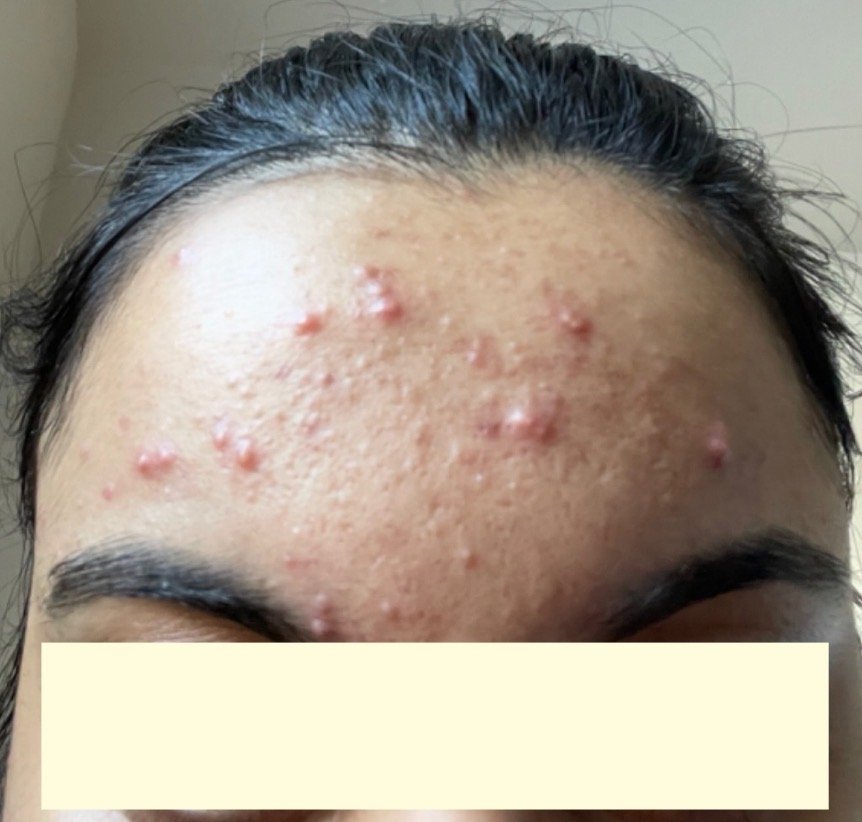 Naturopathic and holistic acne doctor Dr. Sheyda Vadipour helps you heal your acne naturally and achieve clear skin through functional lab testing, hormone and gut healing, and root-cause medicine.