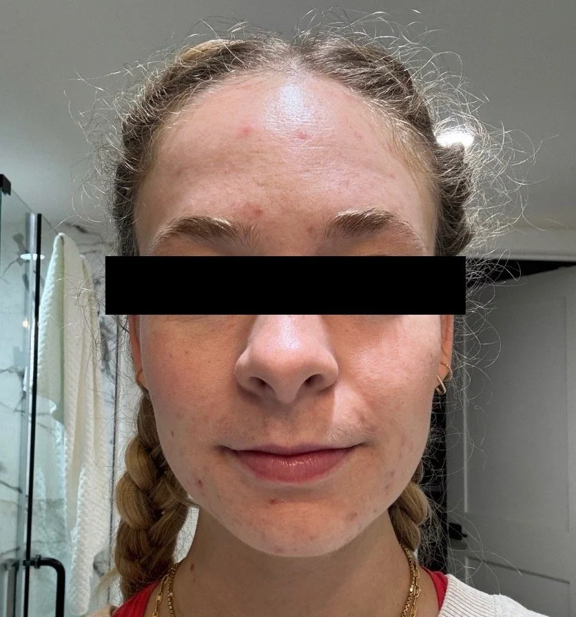 Naturopathic and holistic acne doctor Dr. Sheyda Vadipour helps you heal your acne naturally and achieve clear skin through functional lab testing, hormone and gut healing, and root-cause medicine.