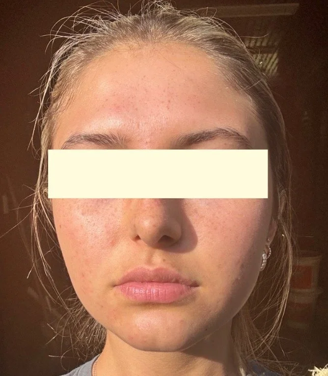 Naturopathic and holistic acne doctor Dr. Sheyda Vadipour helps you heal your acne naturally and achieve clear skin through functional lab testing, hormone and gut healing, and root-cause medicine.