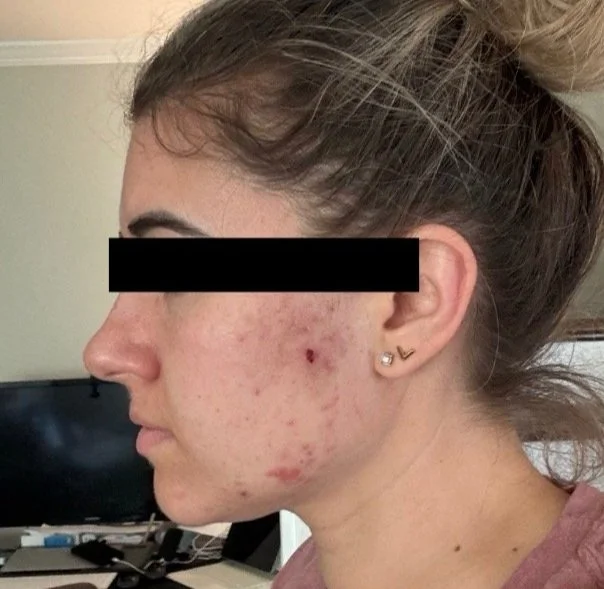 Naturopathic and holistic acne doctor Dr. Sheyda Vadipour helps you heal your acne naturally and achieve clear skin through functional lab testing, hormone and gut healing, and root-cause medicine.