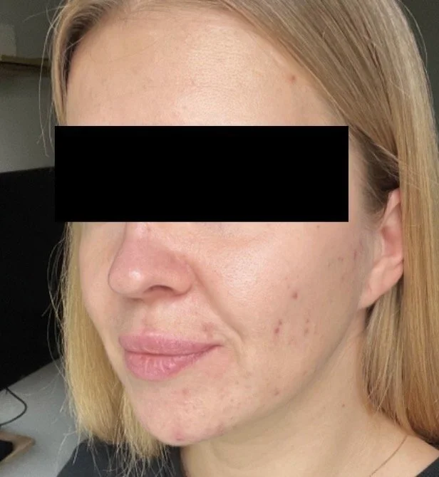 Close-up of a young woman's face with clear skin, light makeup, and blonde hair, with her eyes obscured by a black bar.