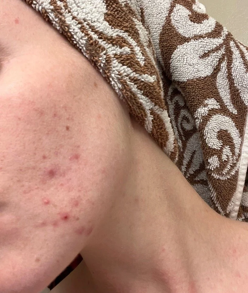 Naturopathic and holistic acne doctor Dr. Sheyda Vadipour helps you heal your acne naturally and achieve clear skin through functional lab testing, hormone and gut healing, and root-cause medicine.