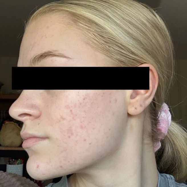 Naturopathic and holistic acne doctor Dr. Sheyda Vadipour helps you achieve lasting heal your acne naturally and achieve clear skin through functional lab testing, hormone and gut healing, and root-cause medicine.