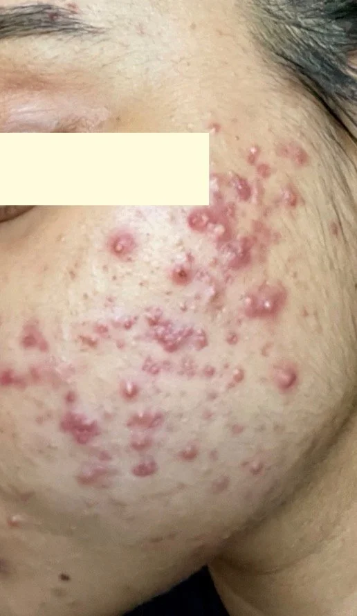 Naturopathic and holistic acne doctor Dr. Sheyda Vadipour helps you heal your acne naturally and achieve clear skin through functional lab testing, hormone and gut healing, and root-cause medicine.