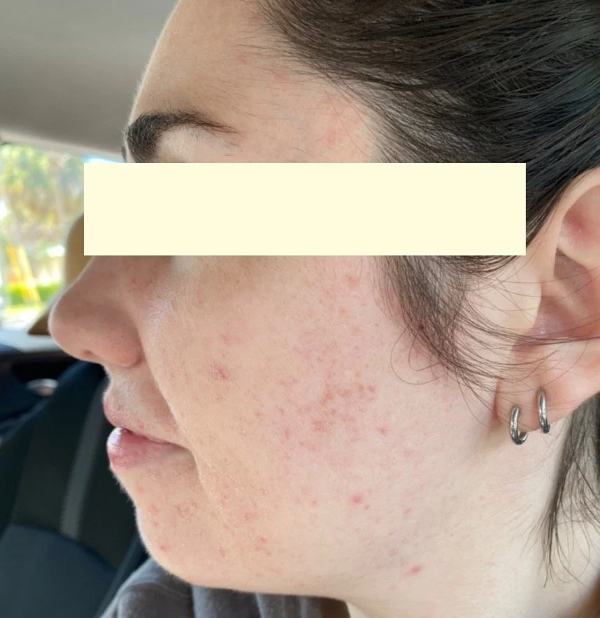 Naturopathic and holistic acne doctor Dr. Sheyda Vadipour helps you heal your acne naturally and achieve clear skin through functional lab testing, hormone and gut healing, and root-cause medicine.