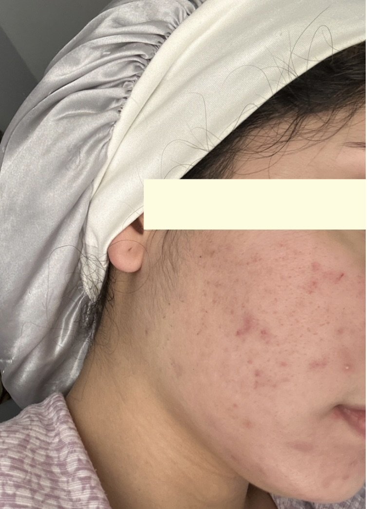 Naturopathic and holistic acne doctor, Dr. Sheyda Vadipour, helping you heal acne naturally and achieve clear skin through functional lab testing, hormone and gut healing, and root-cause medicine.