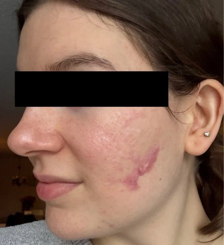 Naturopathic and holistic acne doctor, Dr. Sheyda Vadipour, helping you heal acne naturally and achieve clear skin through functional lab testing, hormone and gut healing, and root-cause medicine.