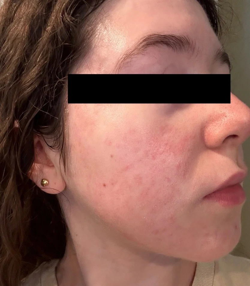 Close-up of a woman's face showing mild acne and skin redness on her cheek and jawline.