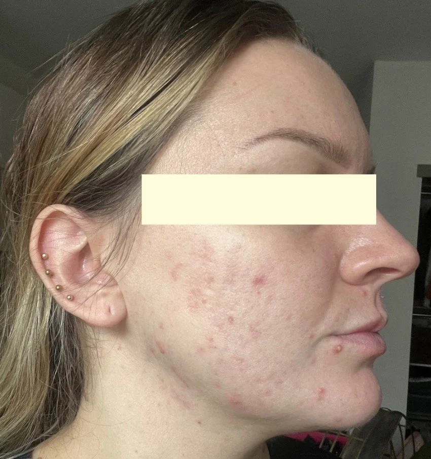 Naturopathic and holistic acne doctor, Dr. Sheyda Vadipour, helping you heal acne naturally and achieve clear skin through functional lab testing, hormone and gut healing, and root-cause medicine.