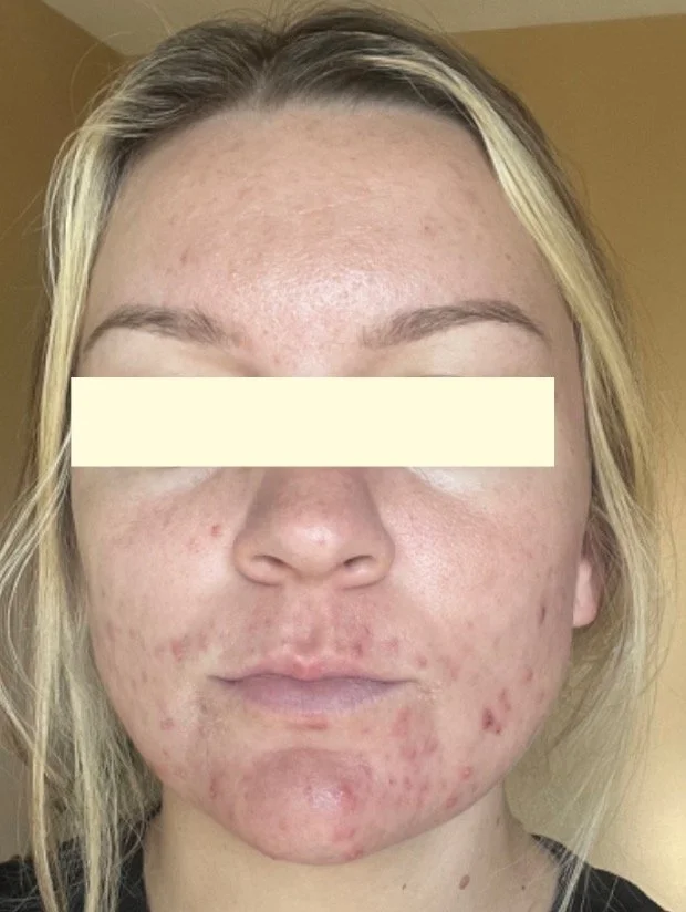Naturopathic and holistic acne doctor, Dr. Sheyda Vadipour, helping you heal acne naturally and achieve clear skin through functional lab testing, hormone and gut healing, and root-cause medicine.