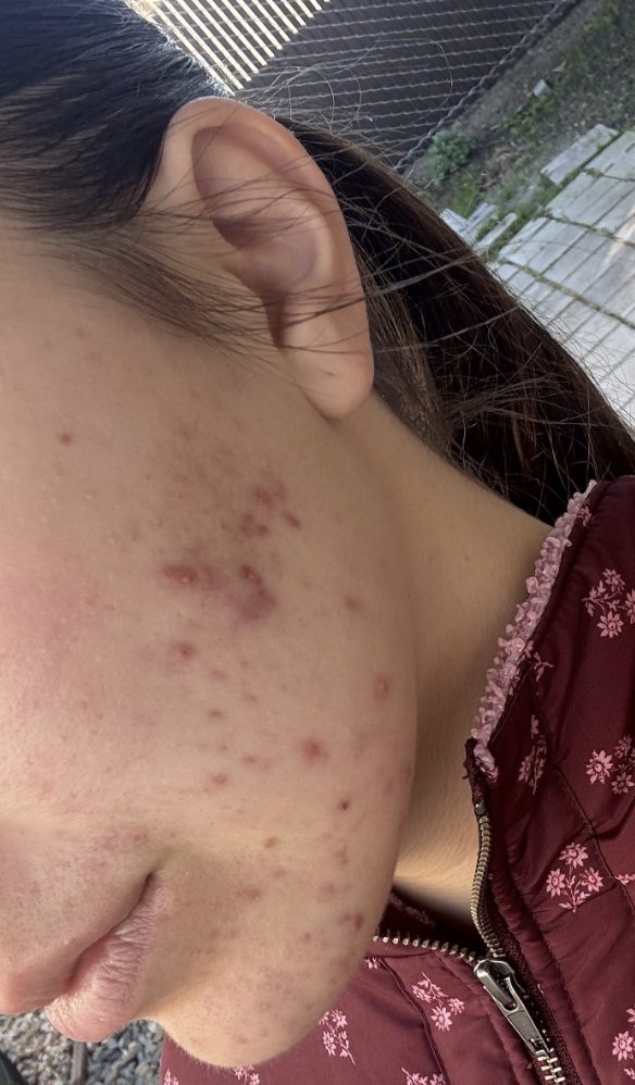 Naturopathic and holistic acne doctor, Dr. Sheyda Vadipour, helping you heal acne naturally and achieve clear skin through functional lab testing, hormone and gut healing, and root-cause medicine.