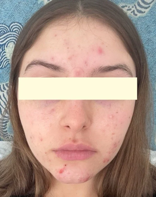 Naturopathic and holistic acne doctor Dr. Sheyda Vadipour helps you heal your acne naturally and achieve clear skin through functional lab testing, hormone and gut healing, and root-cause medicine.