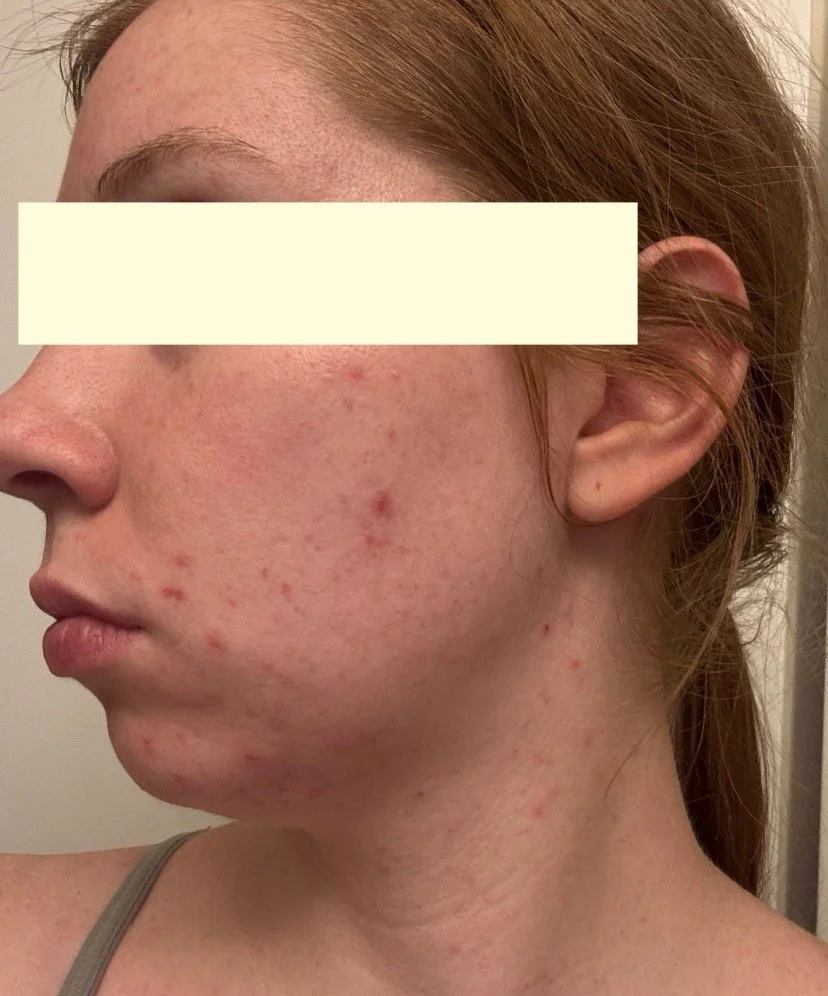 Naturopathic and holistic acne doctor Dr. Sheyda Vadipour helps you heal your acne naturally and achieve clear skin through functional lab testing, hormone and gut healing, and root-cause medicine.