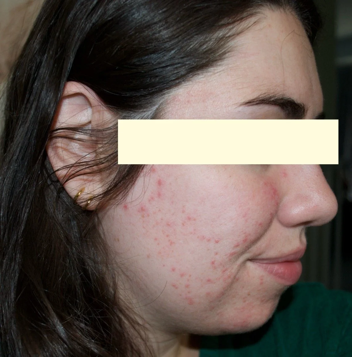 Naturopathic and holistic acne doctor Dr. Sheyda Vadipour helps you heal your acne naturally and achieve clear skin through functional lab testing, hormone and gut healing, and root-cause medicine.