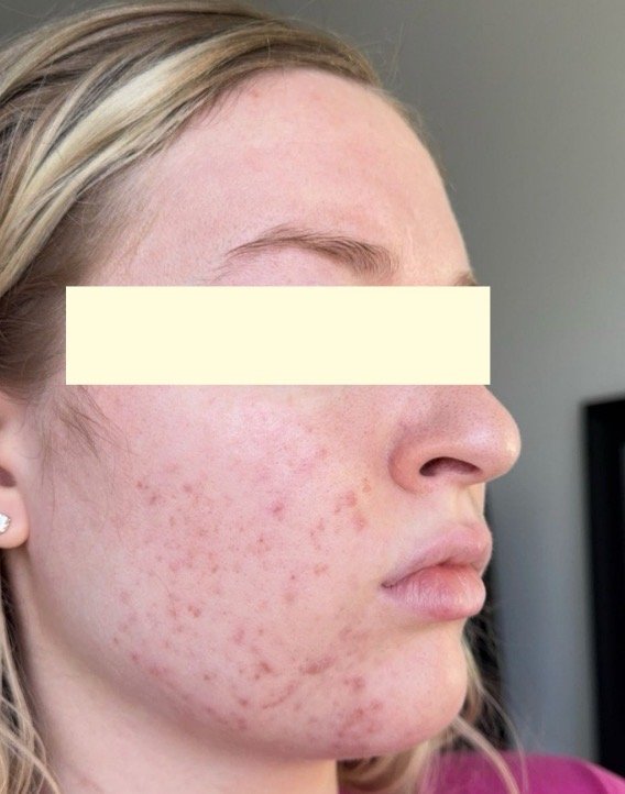 Naturopathic and holistic acne doctor Dr. Sheyda Vadipour helps you heal your acne naturally and achieve clear skin through functional lab testing, hormone and gut healing, and root-cause medicine.