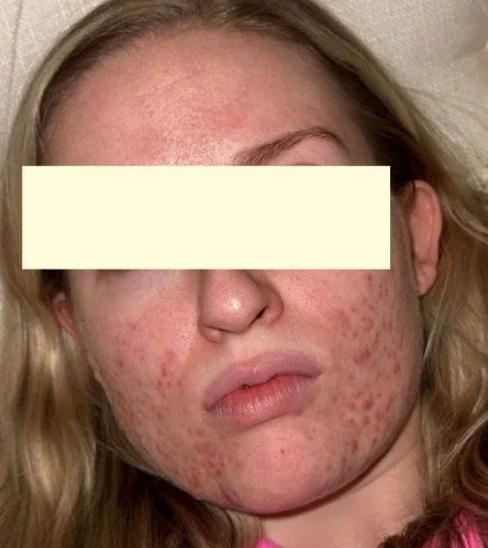 Naturopathic and holistic acne doctor Dr. Sheyda Vadipour helps you heal your acne naturally and achieve clear skin through functional lab testing, hormone and gut healing, and root-cause medicine.