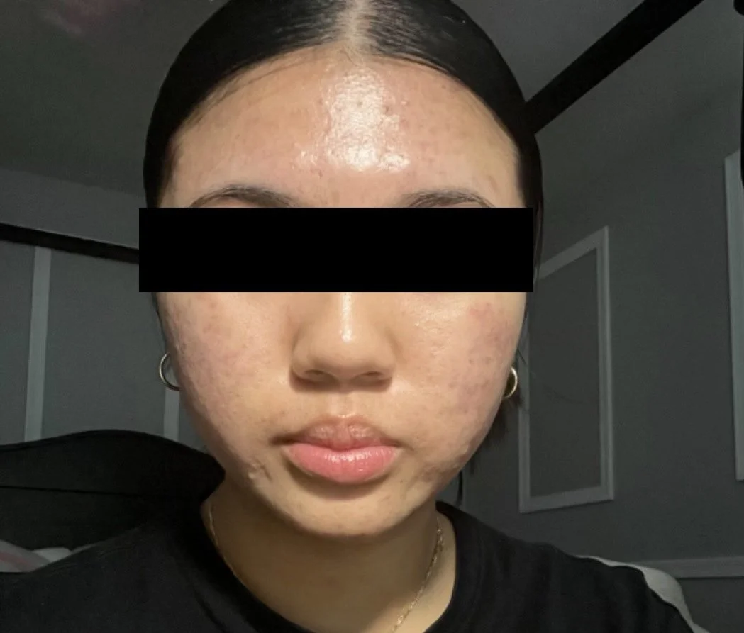 Close-up photo of a woman's face showing acne and skin blemishes with a black bar covering her eyes.