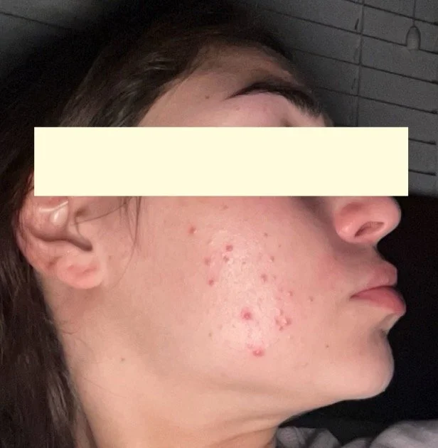 Naturopathic and holistic acne doctor Dr. Sheyda Vadipour helps you heal your acne naturally and achieve clear skin through functional lab testing, hormone and gut healing, and root-cause medicine.