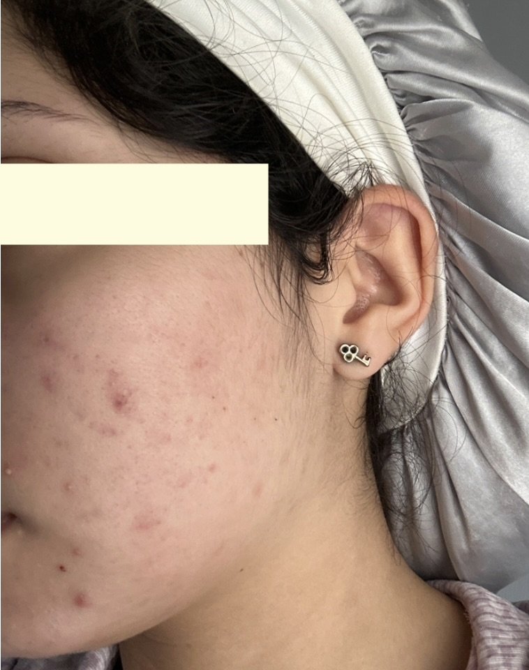 Naturopathic and holistic acne doctor, Dr. Sheyda Vadipour, helping you heal acne naturally and achieve clear skin through functional lab testing, hormone and gut healing, and root-cause medicine.