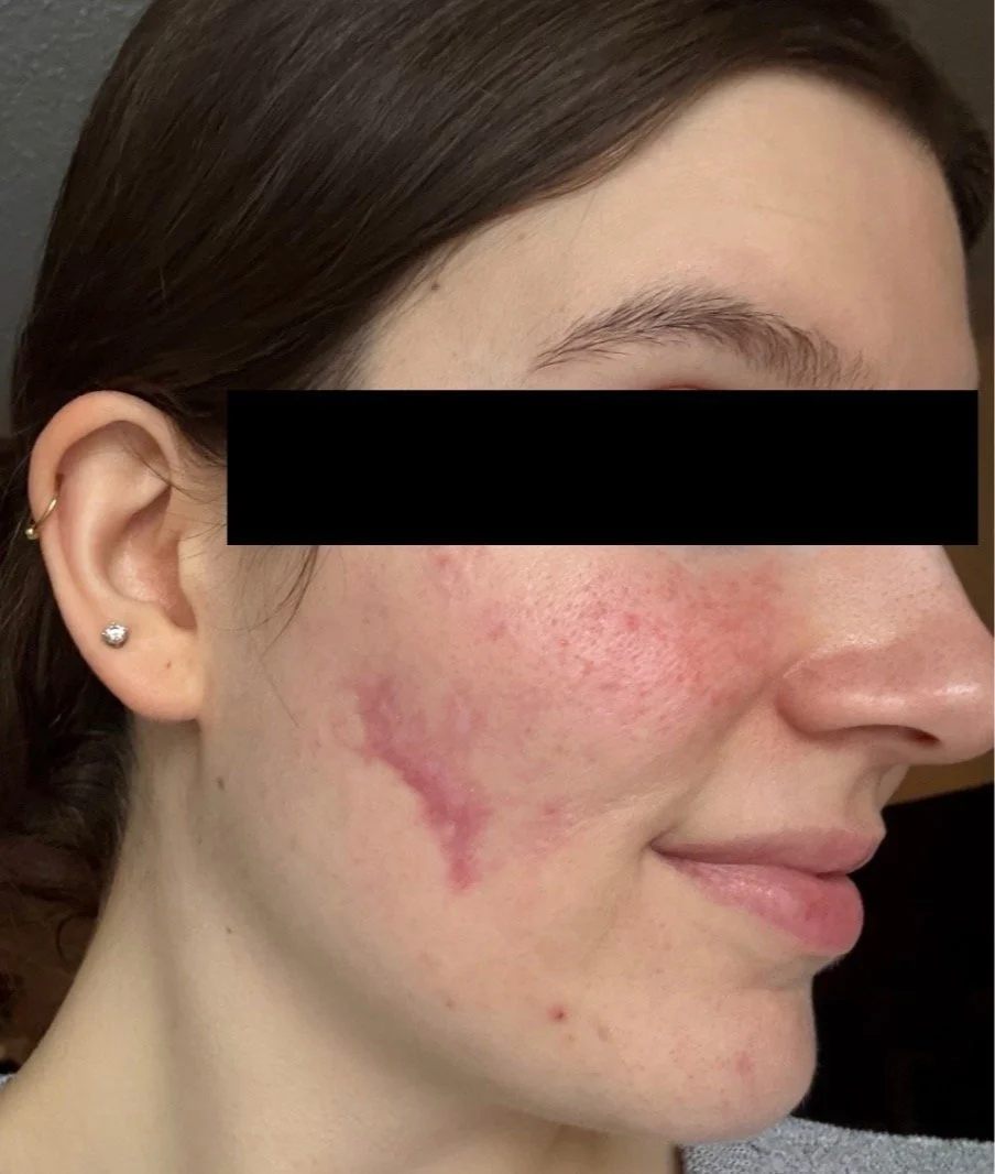 Naturopathic and holistic acne doctor, Dr. Sheyda Vadipour, helping you heal acne naturally and achieve clear skin through functional lab testing, hormone and gut healing, and root-cause medicine.