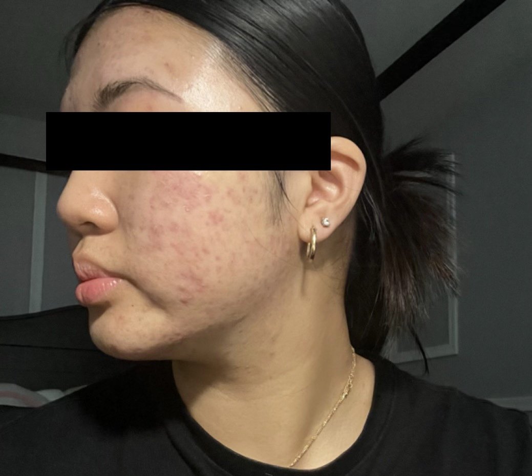 Side profile of a woman with acne scars on her cheek, wearing gold hoop earrings and a gold necklace, with dark hair pulled back.