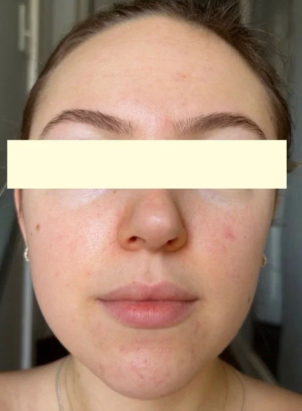 Naturopathic and holistic acne doctor Dr. Sheyda Vadipour helps you heal your acne naturally and achieve clear skin through functional lab testing, hormone and gut healing, and root-cause medicine.